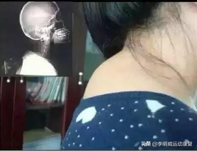 颈后鼓包动作,颈后大包如何处理