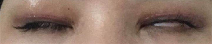 欧式大双眼皮和平行双眼皮,醒醒吧明智的放弃胜过盲目的执着