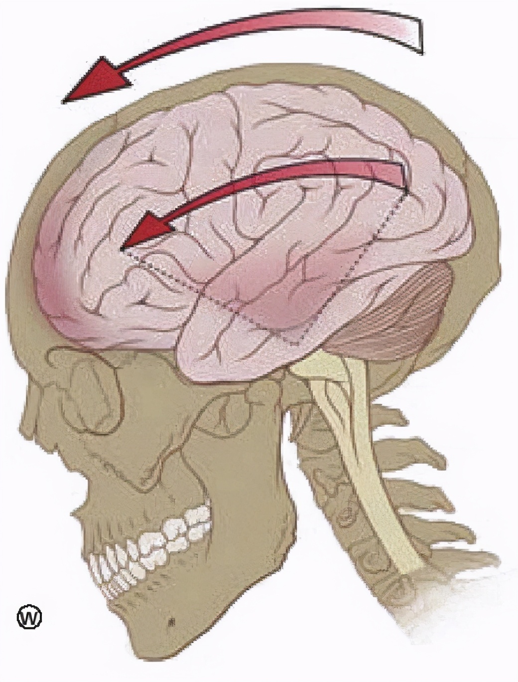 用头撞墙会脑震荡吗,拖鞋打头顶会打成脑震荡吗