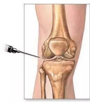 磁共振检查半月板损伤有误诊率吗,半月板磁共振会不会有误诊