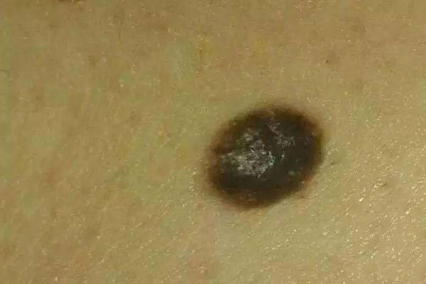 身上突然长咖啡色肉痣是咋回事,身上出现红色痣一定与肝脏有关吗