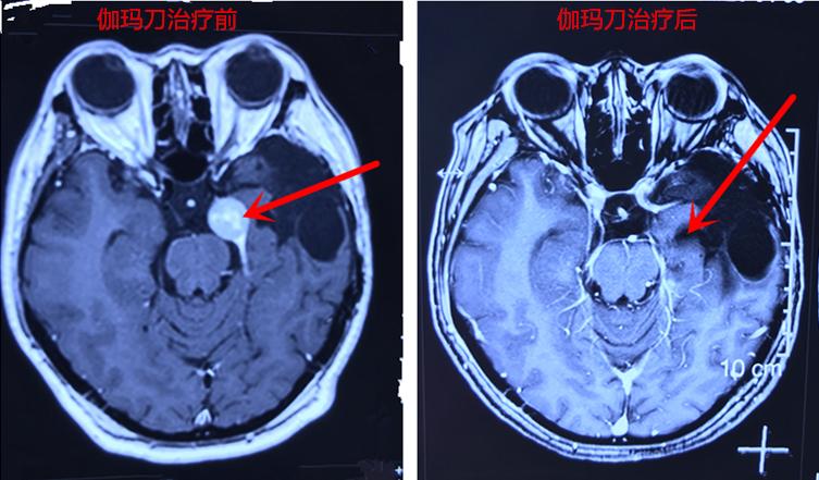 脑部肿瘤可以通过鼻子切除吗,脑部肿瘤手术后应该怎样治疗
