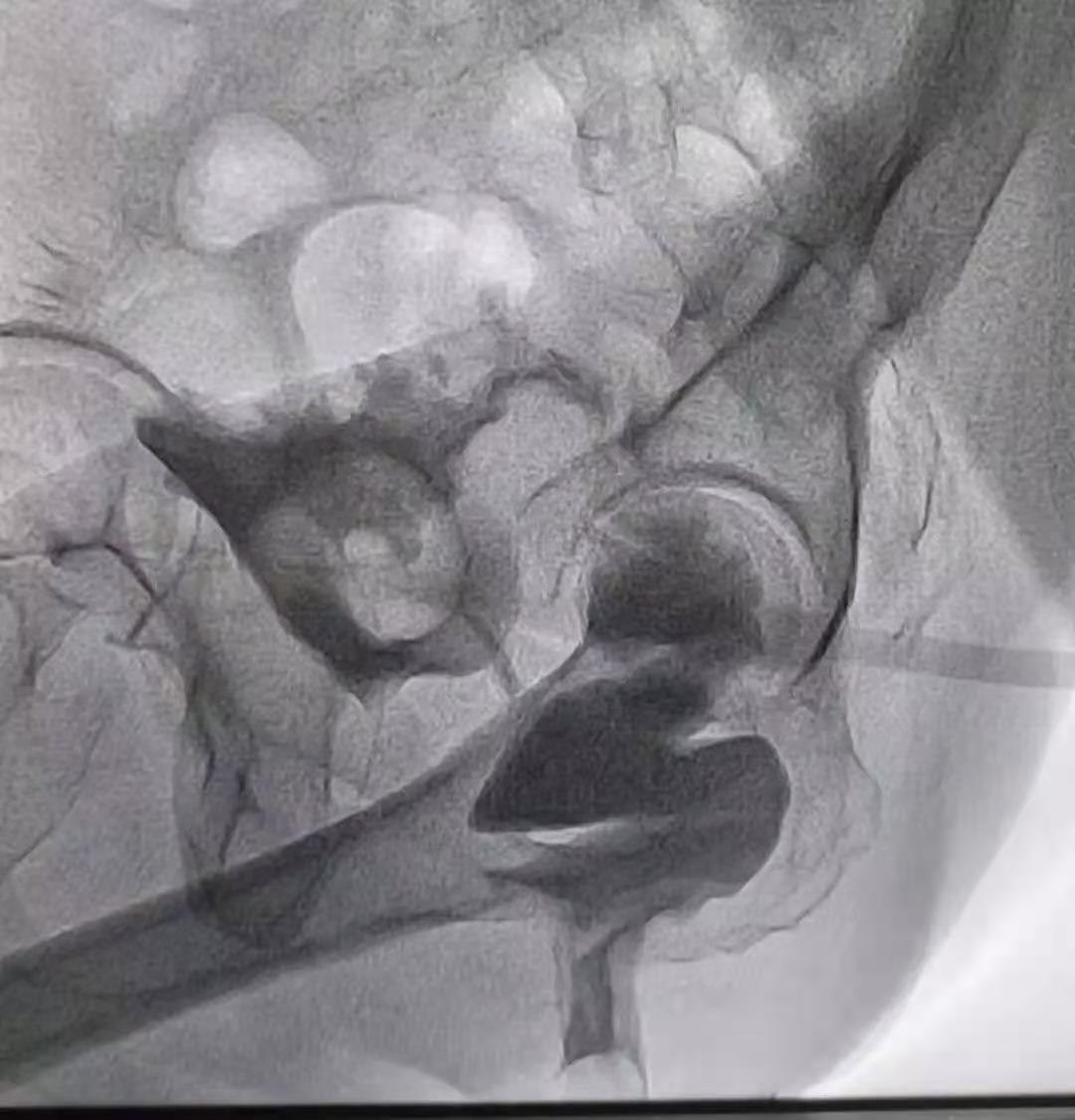 克罗恩病能不能自行缓解,克罗恩病在什么情况下需长期用药