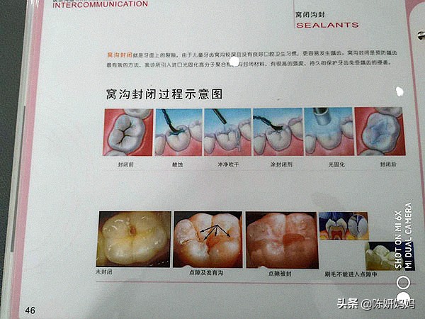 蛀牙都是吃糖惹的祸?别冤枉孩子了,牙医告诉你实情!