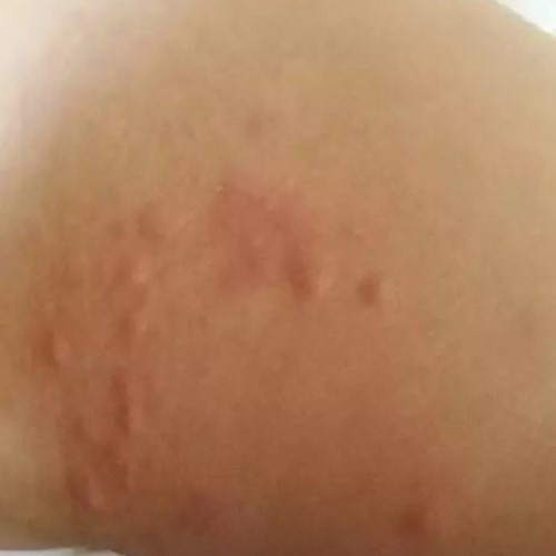 宝宝总是起小疙瘩是怎么回事,宝宝背后小疙瘩怎么解决