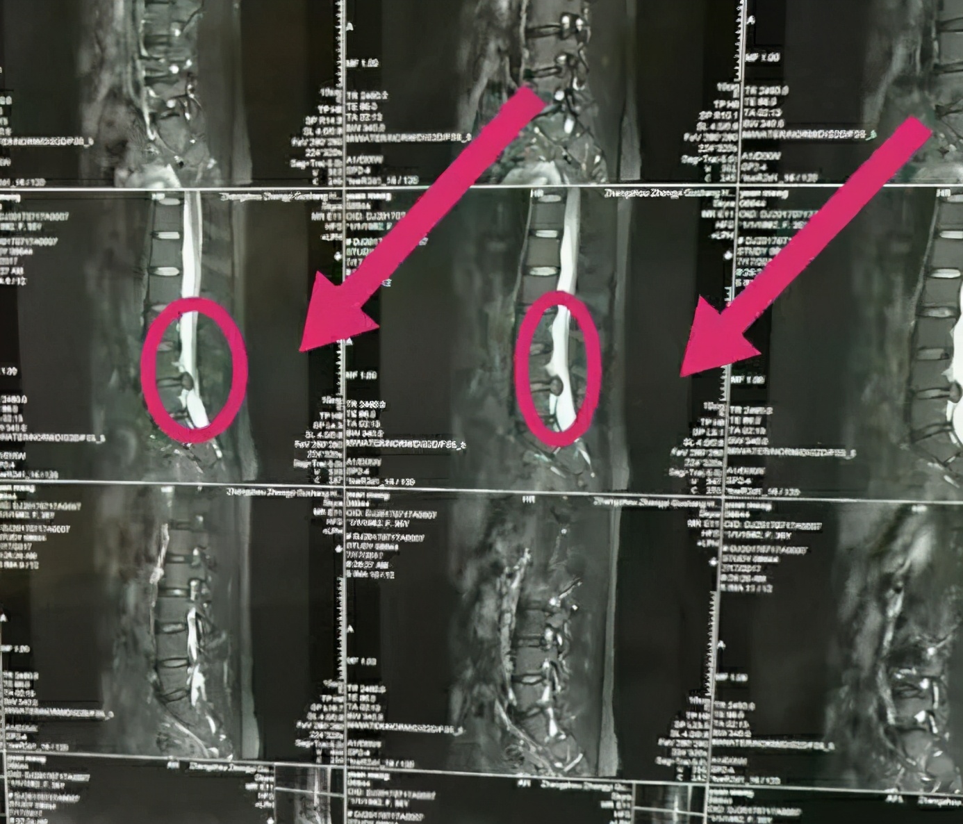 牵引动作治疗腰间盘突出,牵引法治疗腰间盘突出操作