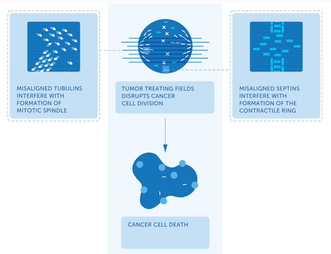 中国首款肿瘤电场疗法将至,肿瘤电场治疗仪
