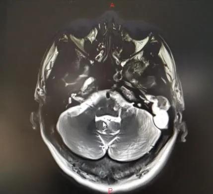 中耳炎里面长了个瘤子,中耳炎长瘤子