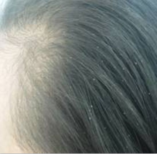 12岁女孩头皮屑多到可怕一梳一堆,12岁女孩头皮屑超多是什么原因