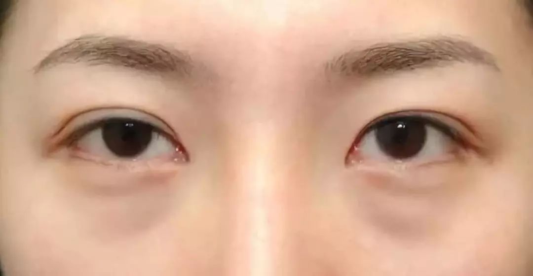 马应龙八宝眼袋型眼膜,马应龙八宝多肽眼膜