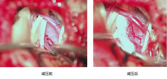 面肌痉挛怎么治右眼跳动,右眼皮跳5天会是面肌痉挛吗