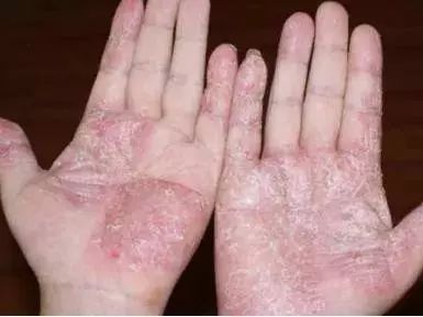 皮肤湿疹万能膏,泰国顽固性皮肤病排毒止痒膏