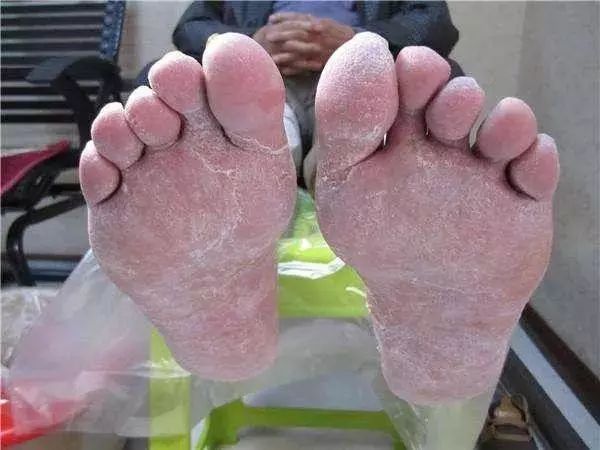 泰国治癣的药膏排行榜,泰国治疗皮肤癣的药膏