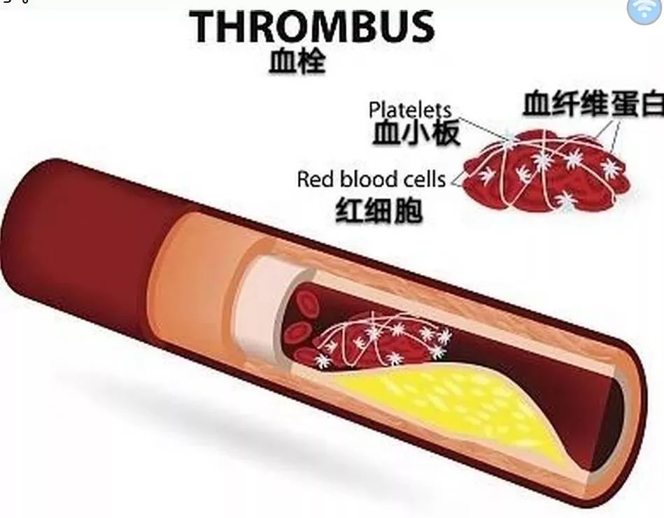 颈动脉血管硬化的症状和危害,颈动脉硬化和不均匀增厚