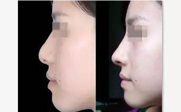 玻尿酸填充是个无底洞吗,玻尿酸是不是无底洞