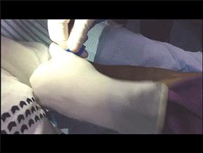 打针输液时空气进入了血管，我是不是要死了？