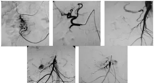 微创介入治疗肿瘤是什么科,介入治疗肿瘤副作用