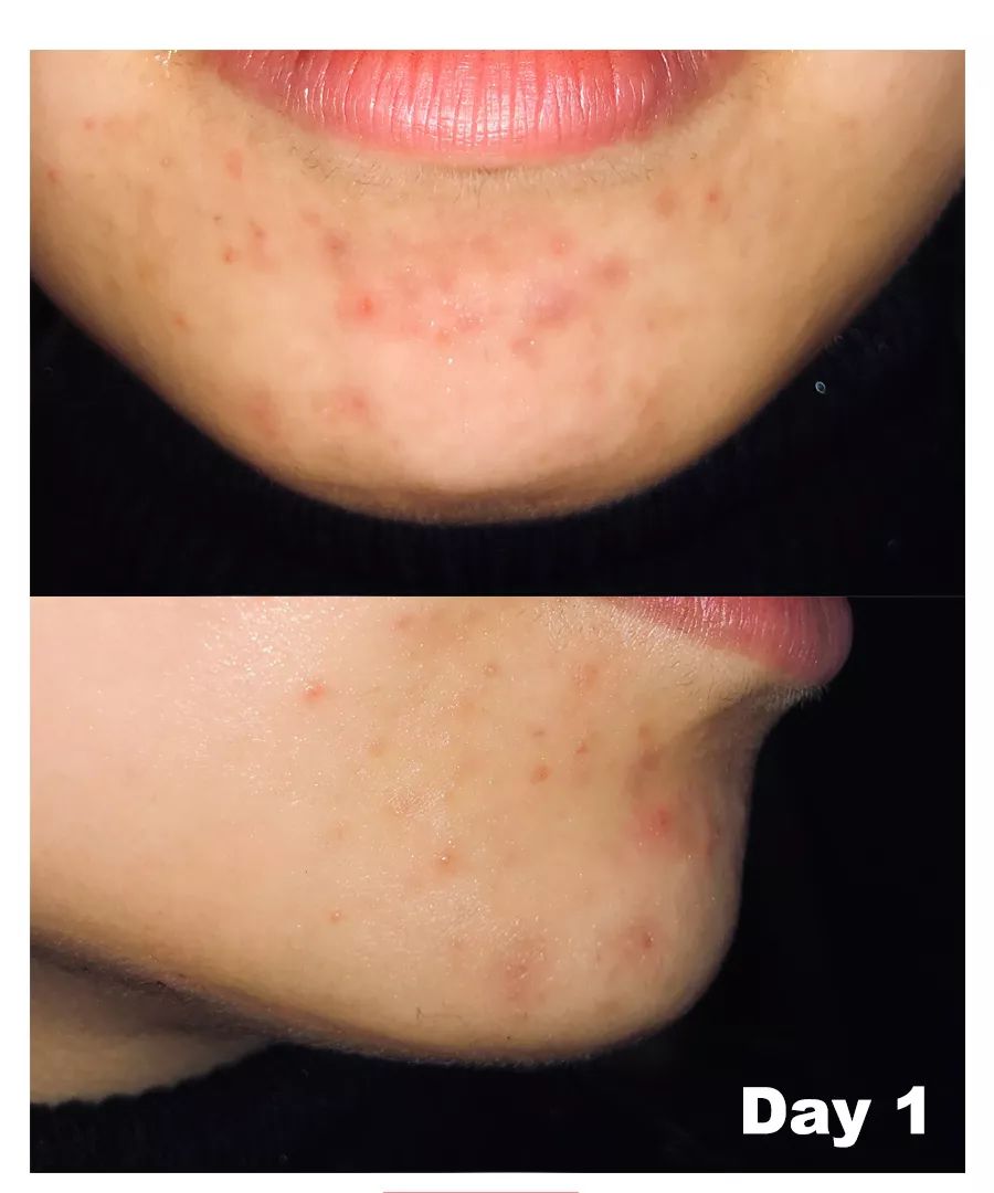 怎么对付闭口,终于找到了对抗失眠的良方