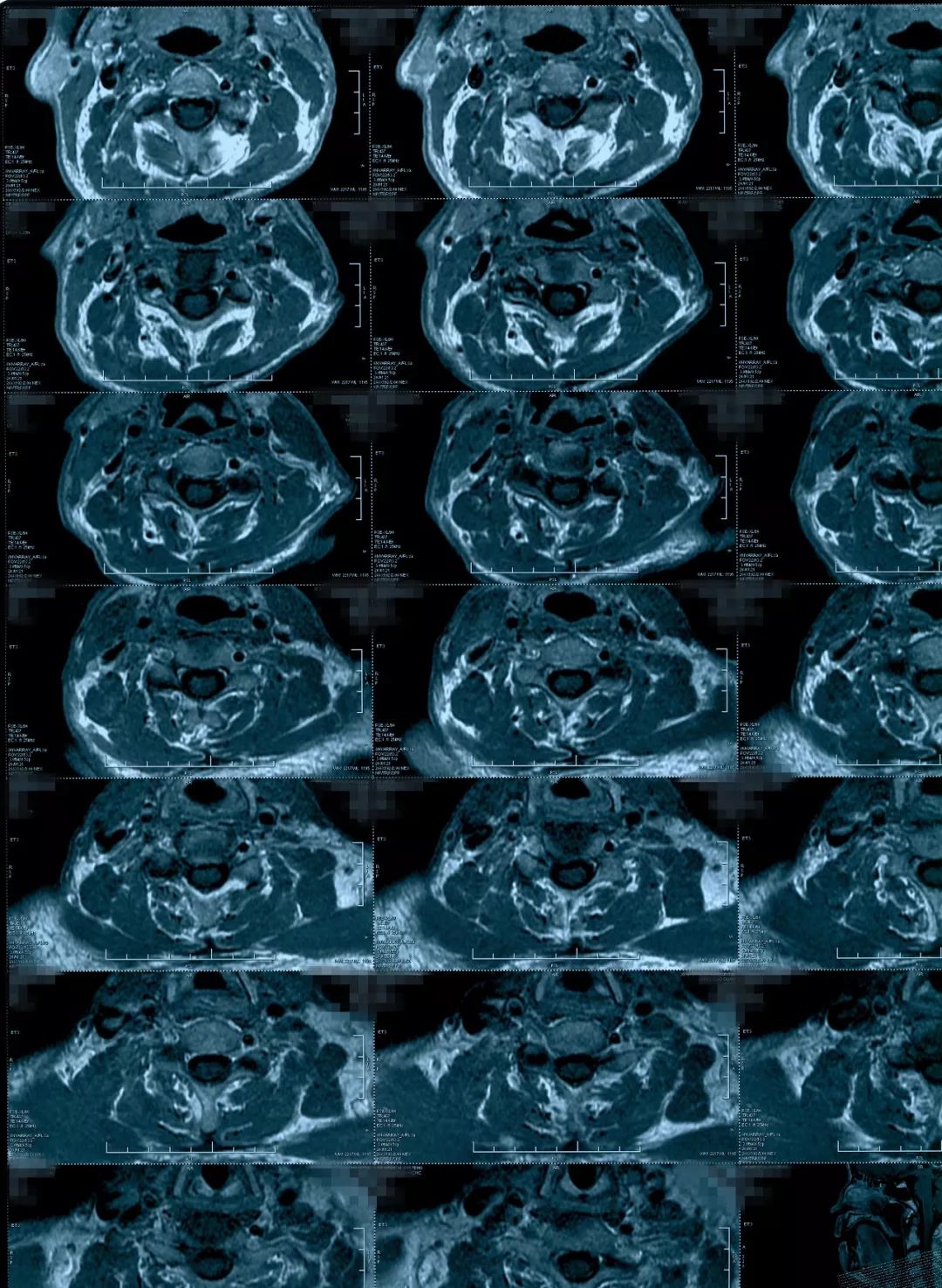 椎管狭窄水肿最佳治疗方法,椎管水肿如何治疗