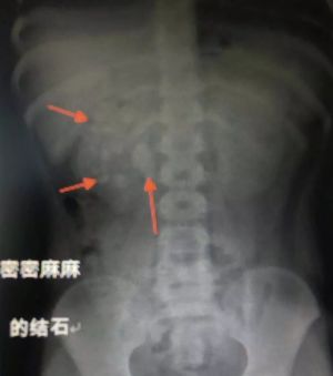 9岁娃肾里塞满56个结石,九岁孩子体内取出56颗结石