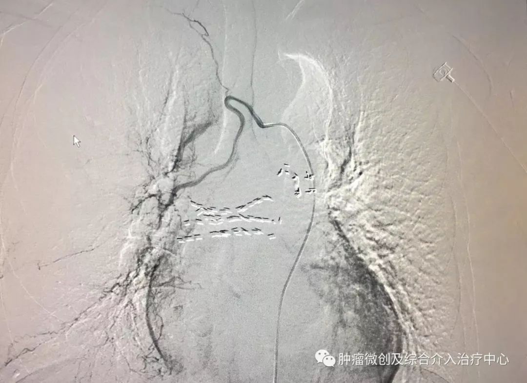 运城市第一医院肿瘤科咋样,运城第一医院治疗肿瘤怎么样