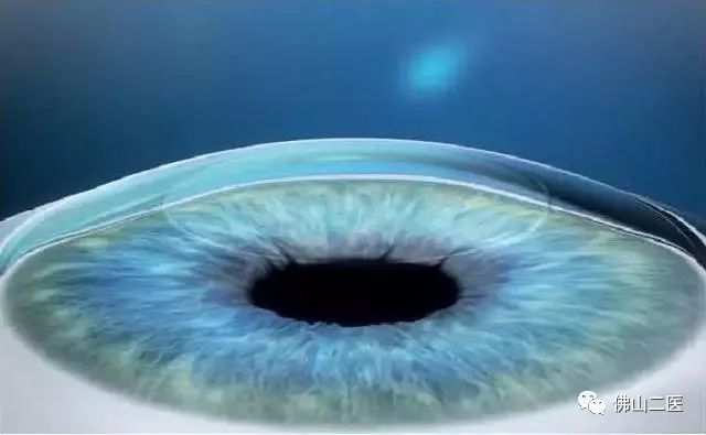 激光近视手术需要多少钱,做近视手术后需要注意事项