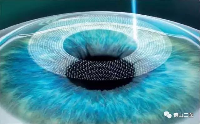 激光近视手术需要多少钱,做近视手术后需要注意事项