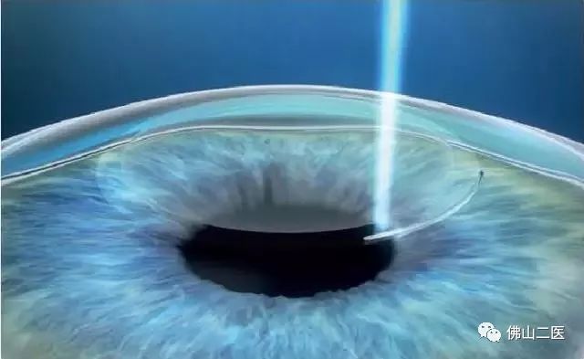 激光近视手术需要多少钱,做近视手术后需要注意事项