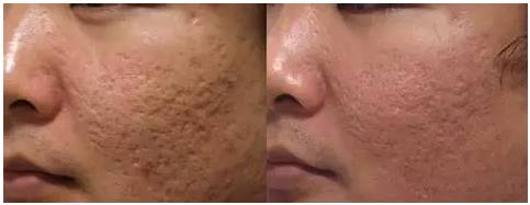 激光美容技术有用吗,解读激光美容的六大疑惑