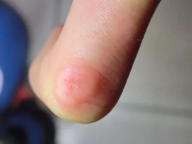 冻疮痒怎么办6大妙招帮你缓解,冻疮太疼怎么缓解