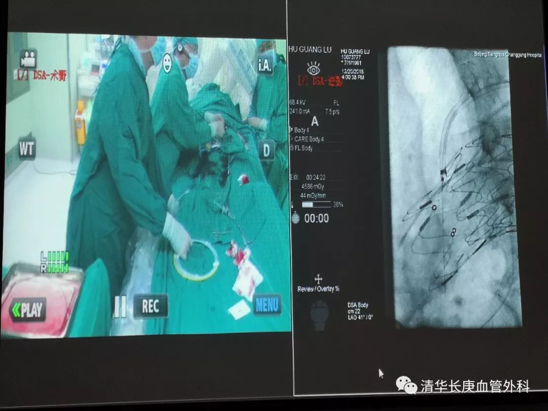 教学相长共同成长,北京清华长庚医院周围血管外科