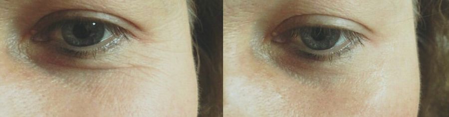 神奇的原液去皱纹眼袋,眼袋抗皱纹精华液