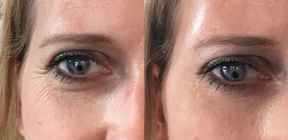 神奇的原液去皱纹眼袋,眼袋抗皱纹精华液