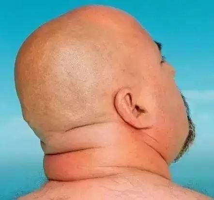 后脑勺堆肉脑梗的前兆,后脑勺脑梗纹怎么缓解