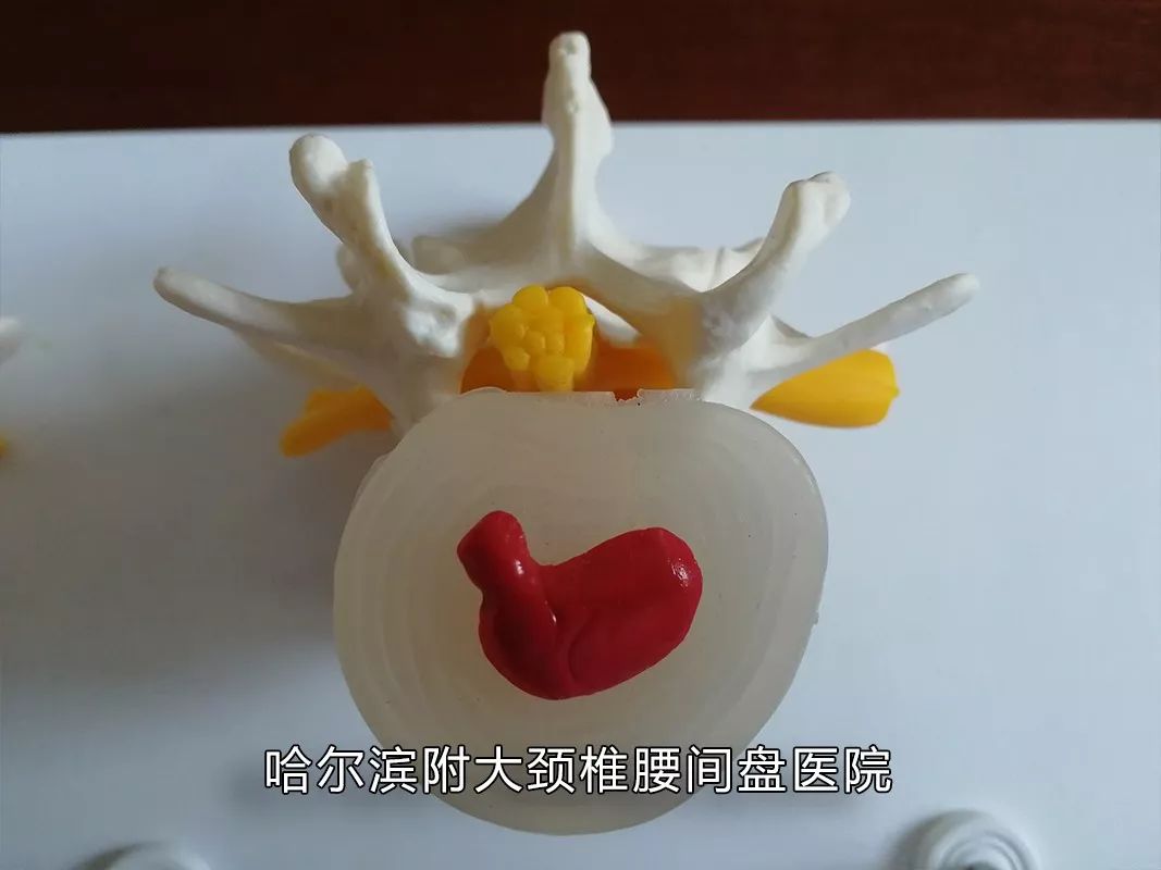 你家睡啥床?你常玩手机?腰痛难忍反复发作、久治不愈,腰间的不能承受之痛该如何缓解?