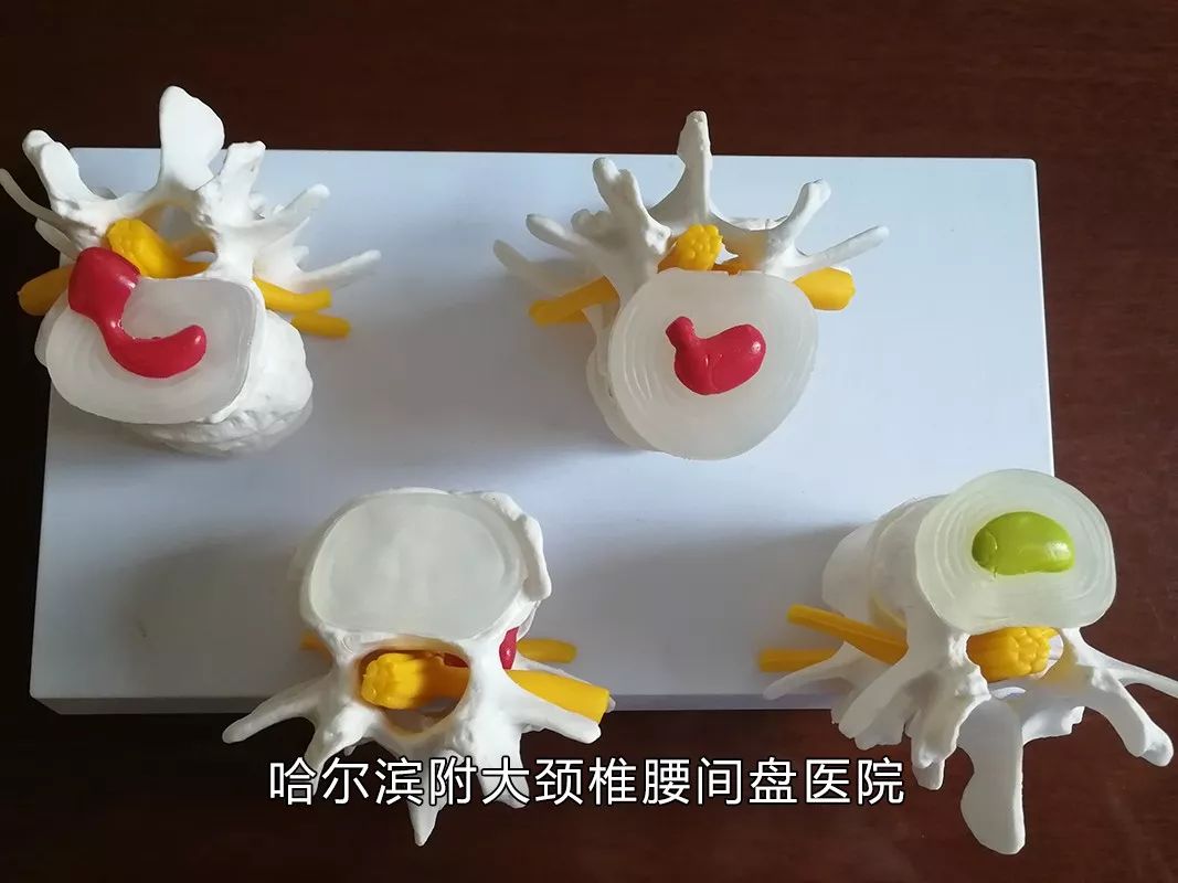 你家睡啥床?你常玩手机?腰痛难忍反复发作、久治不愈,腰间的不能承受之痛该如何缓解?