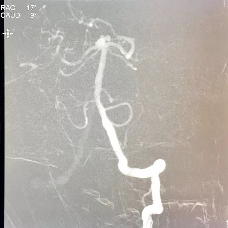 柳暗花明专栏|栓塞颅内动脉瘤时微导管无法穿过LVIS支架网眼怎么办