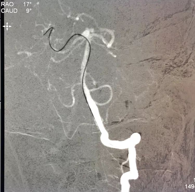 柳暗花明专栏|栓塞颅内动脉瘤时微导管无法穿过LVIS支架网眼怎么办