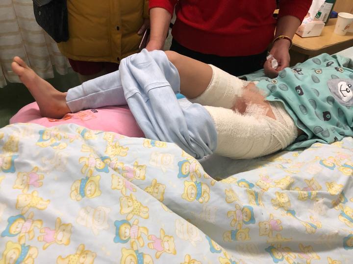 男孩看电视发现屋内电器着火灭火,孩子玩取暖器被烧伤