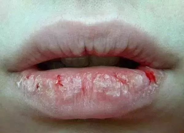 快速解决嘴唇干裂起皮的方法,如何改善唇部干燥起皮