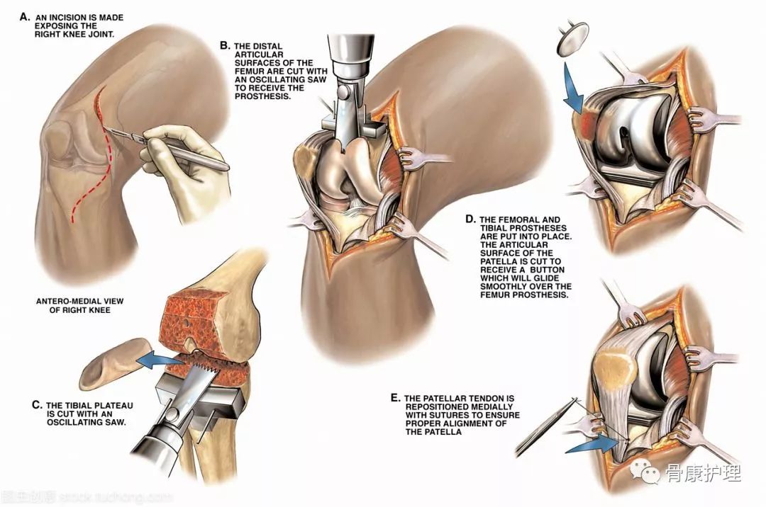 滑膜发炎有积液怎么办,滑膜发炎是什么原因引起的