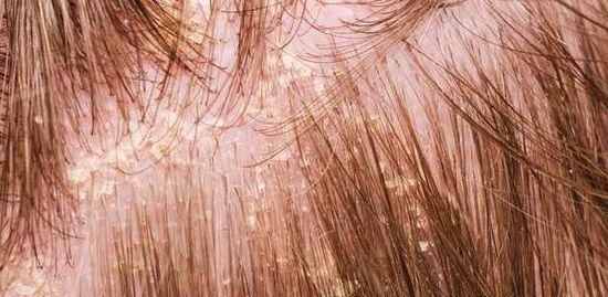 头上头皮屑和剪发虫怎么解决,头皮屑多且大块还结痂会不会有虫