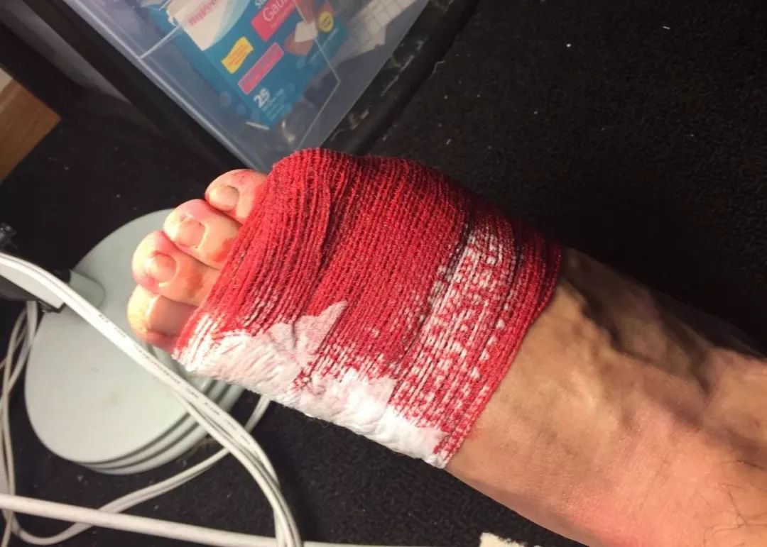 俄罗斯留学生骨折截肢,留学生意外被截肢