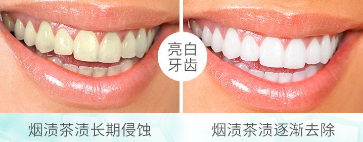 牙黄口臭三分钟见效,牙黄口臭去烟渍