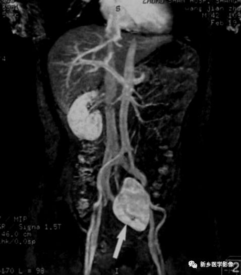 肾脏疾病鉴别五项意义,肾脏病理分型及临床表现