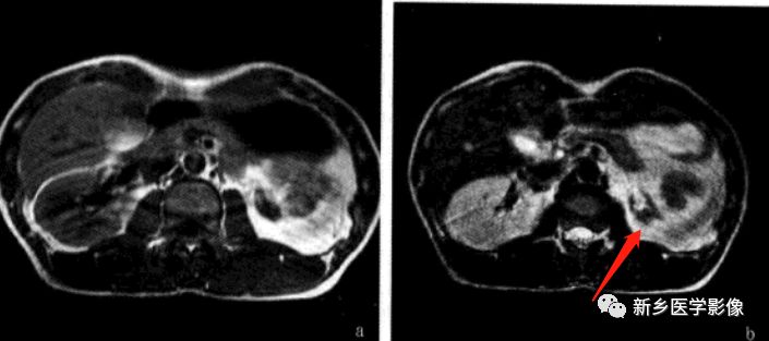 肾脏疾病鉴别五项意义,肾脏病理分型及临床表现