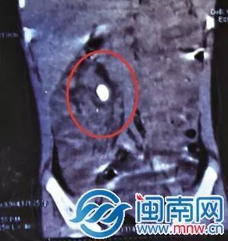 2岁后孩子喝纯牛奶会得肾结石吗,小孩喝纯牛奶得肾结石是什么原因