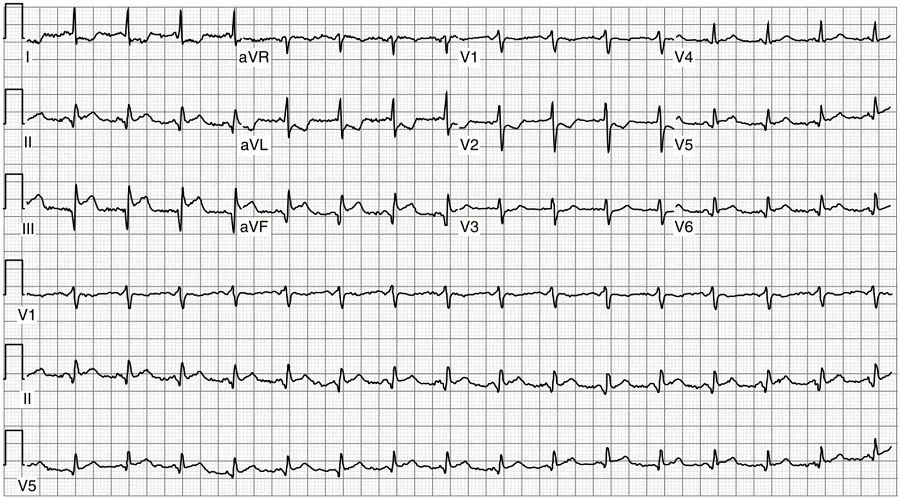 心肌梗死术后出现心衰的临床表现,心梗合并心衰的护理疑难病例讨论