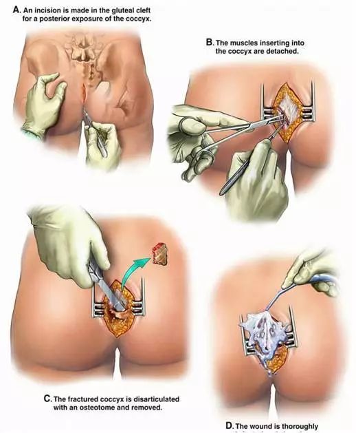 尾骨骨折是什么症状,骶尾骨骨折注意事项