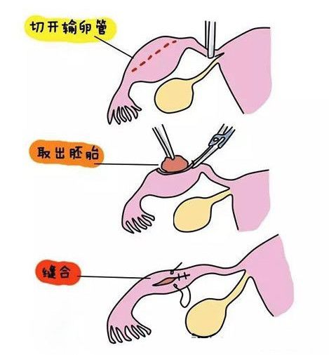 找错位置的受精卵——宫外孕
